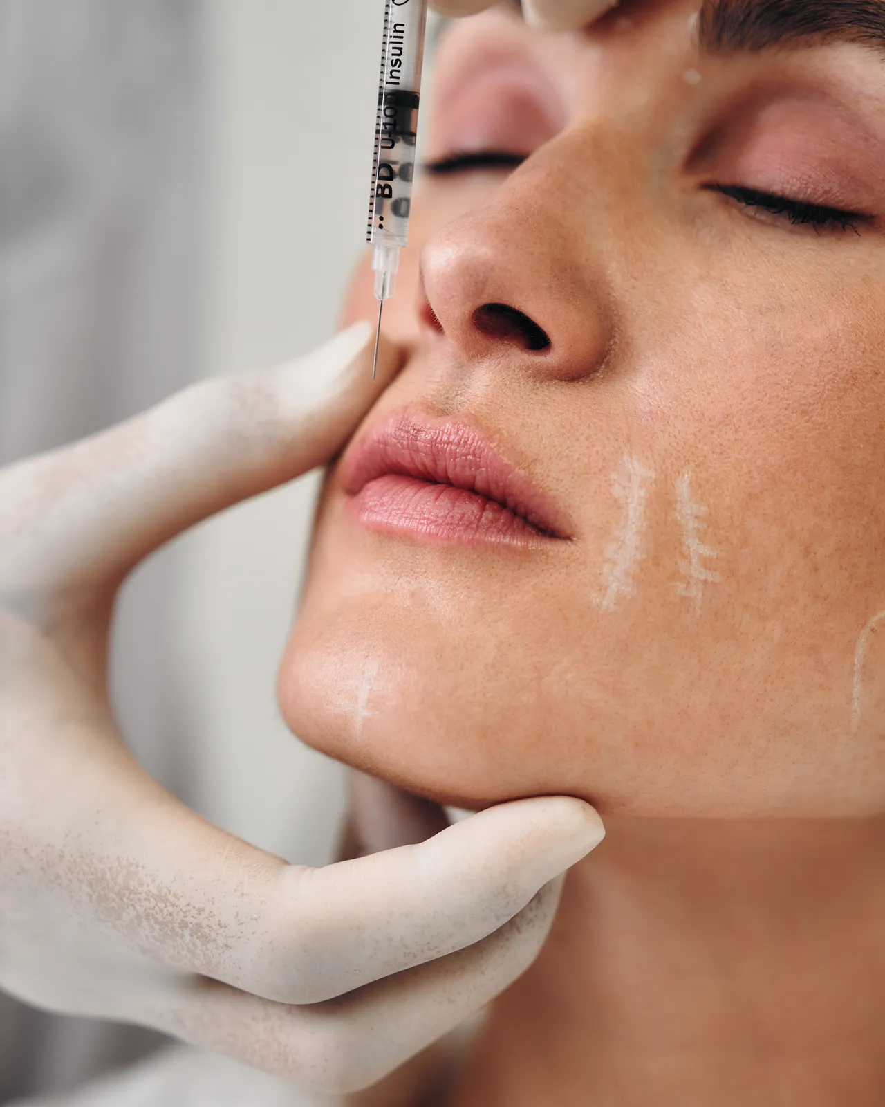 Hyaluronic acid injection in the cheek area