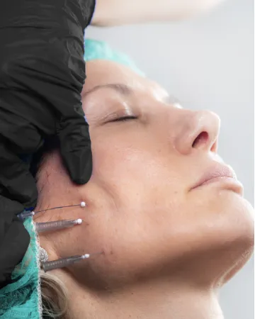 Placement of fine threads in the face