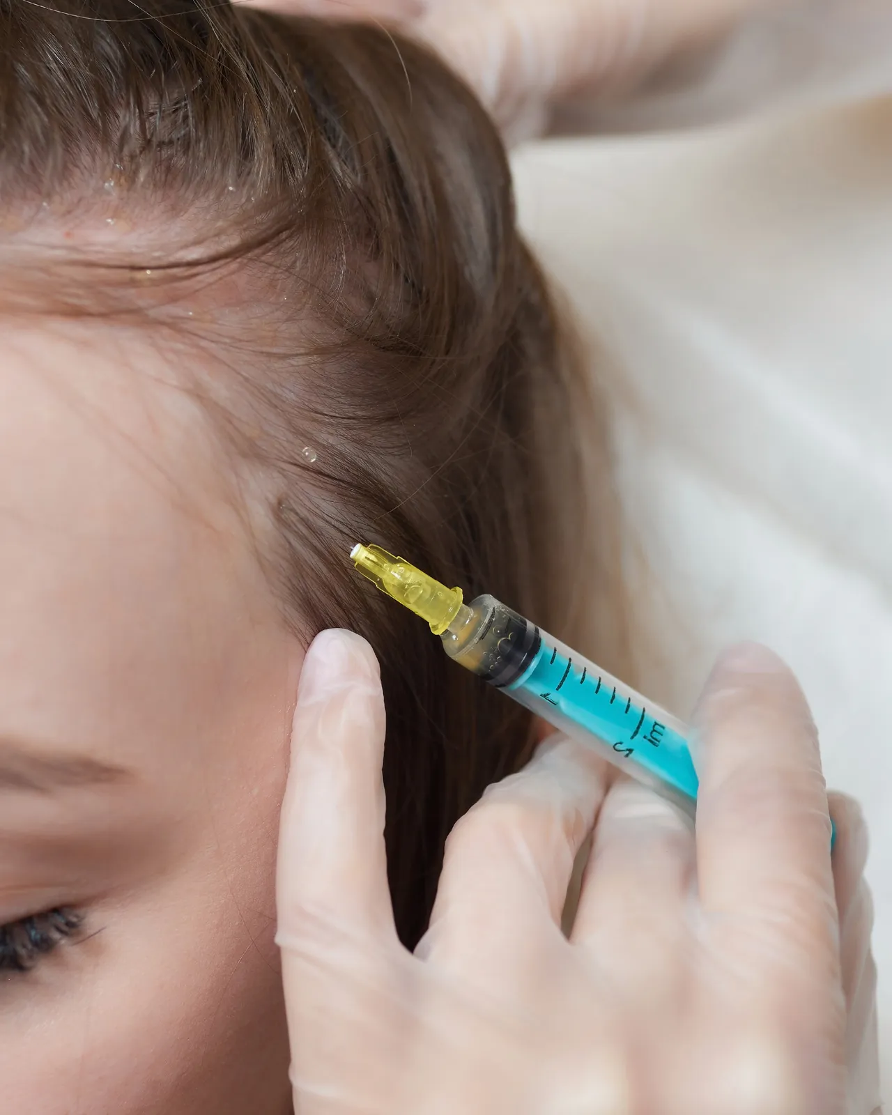 Injection into the scalp