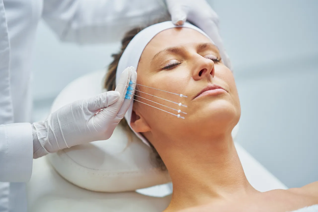 Patient with facial markings before an aesthetic treatment
