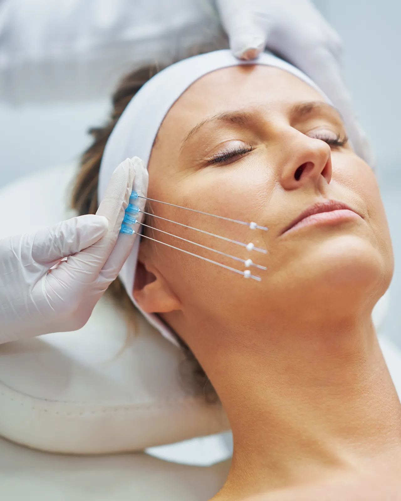 Patient with facial markings before an aesthetic treatment